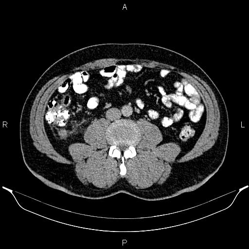 Acute appendicitis (Radiopaedia 84780-100240 Axial C+ portal venous phase 60).jpg