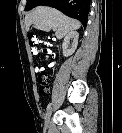Acute appendicitis (Radiopaedia 84780-100240 Sagittal C+ portal venous phase 33).jpg