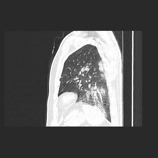 File:Acute appendicitis and COVID 19 pneumonia (Radiopaedia 76604-88380 Sagittal lung window 73).jpg