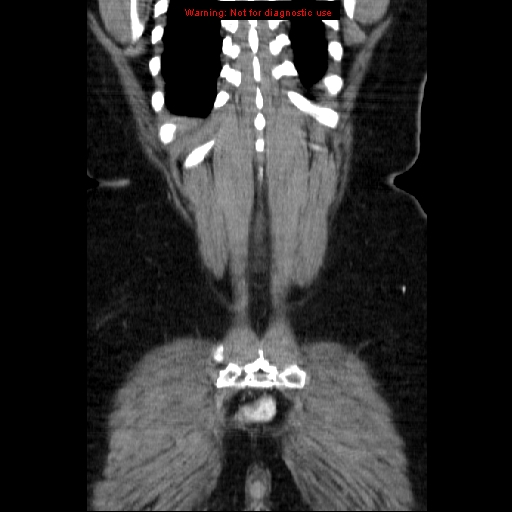 File:Acute appendicitis complicated by ovarian vein thrombophlebitis (Radiopaedia 16172-15851 Coronal C+ portal venous phase 73).jpg