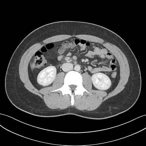Acute appendicitis with appendicoliths (Radiopaedia 50186-55532 Axial C+ portal venous phase 39).png