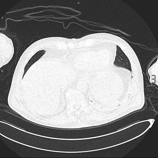 Acute aspiration pneumonitis (Radiopaedia 55642-62166 Axial lung window 128).jpg