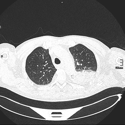 Acute aspiration pneumonitis (Radiopaedia 55642-62166 Axial lung window 51).jpg
