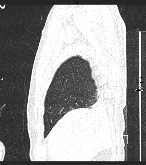 Acute aspiration pneumonitis (Radiopaedia 55642-62166 Sagittal lung window 136).jpg