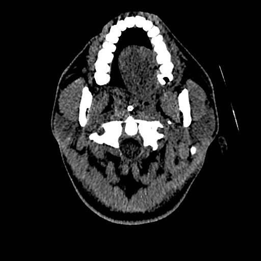 Acute basilar artery occlusion (Radiopaedia 43582-46985 Axial non-contrast 15).jpg