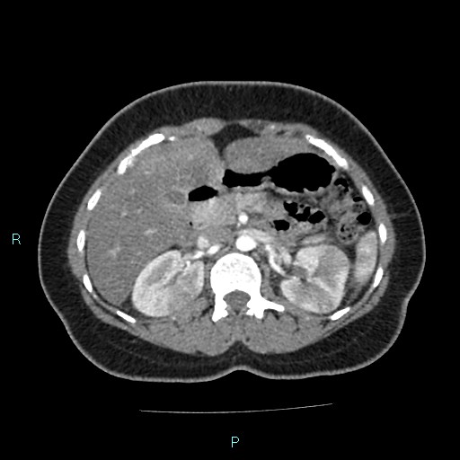 Acute bilateral pyelonephritis (Radiopaedia 37146-38881 Axial C+ arterial phase 66).jpg