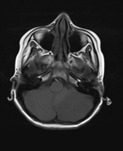 File:Acute cerebellar ataxia (Radiopaedia 61487-69446 Axial T1 4).jpg