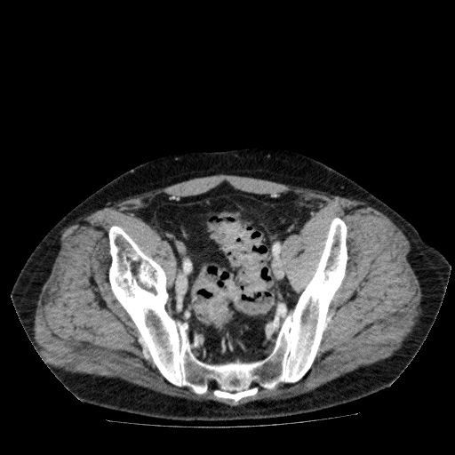 Acute cholecystitis and incidental left sided IVC (Radiopaedia 49352-54459 Axial C+ portal venous phase 129).jpg