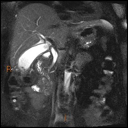 File:Acute cholecystitis with gallbladder neck calculus (Radiopaedia 42795-45971 Coronal T2 Half-fourier-acquired single-shot turbo spin echo (HASTE) 4).jpg