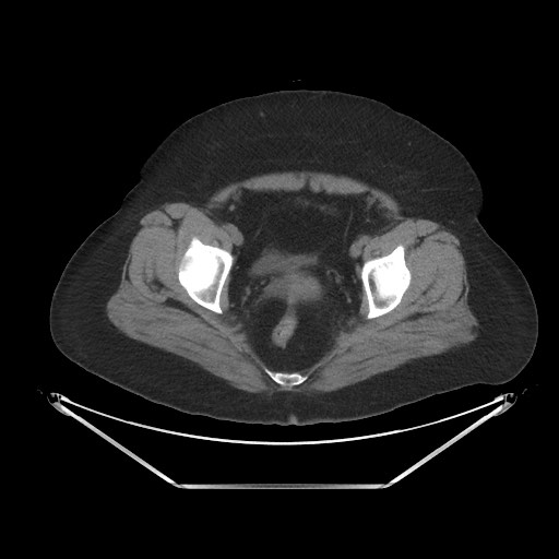 File:Acute cholecystitis with tensile fundus sign (Radiopaedia 71394-81723 Axial non-contrast 106).jpg
