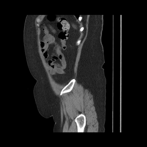 Acute cholecystitis with tensile fundus sign (Radiopaedia 71394-81723 Sagittal non-contrast 140).jpg