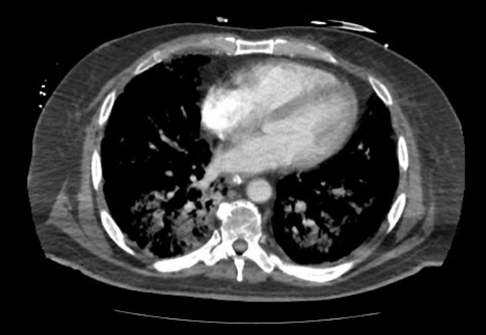 Acute cor pulmonale (ultrasound) (Radiopaedia 83508-98818 Axial C+ CTPA 50).jpg