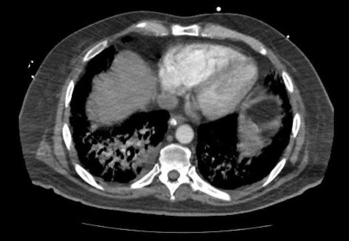Acute cor pulmonale (ultrasound) (Radiopaedia 83508-98818 Axial C+ CTPA 58).jpg