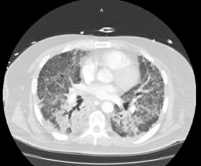 Acute cor pulmonale (ultrasound) (Radiopaedia 83508-98818 Axial lung window 49).jpg