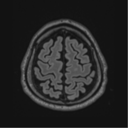 Acute disseminated encephalomyelitis (ADEM)- Anti-NMDA receptor encephalitis (Radiopaedia 54920-61201 Axial FLAIR 59).png