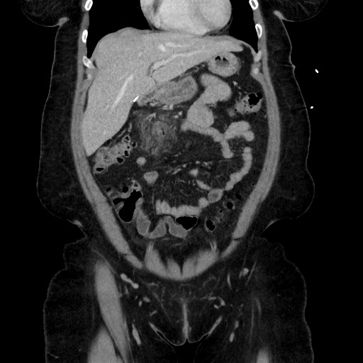 Acute diverticulitis - transverse colon (Radiopaedia 87063-103327 Coronal C+ portal venous phase 62).jpg
