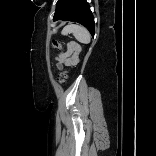 Acute diverticulitis - transverse colon (Radiopaedia 87063-103327 Sagittal C+ portal venous phase 177).jpg