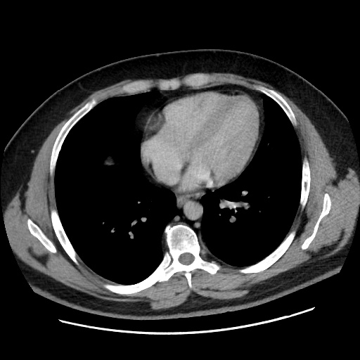 File:Acute diverticulitis with localized perforation (Radiopaedia 41296-44113 Axial C+ portal venous phase 5).jpg
