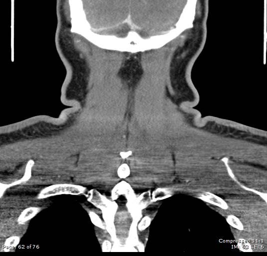 Acute epiglottitis (Radiopaedia 54375-60590 Coronal C+ arterial phase 62).jpg
