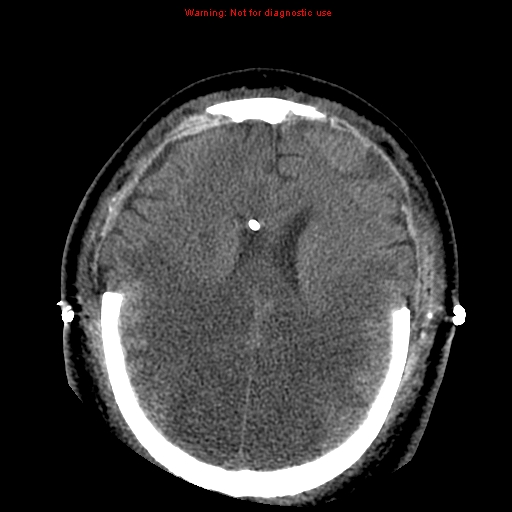 File:Acute hemorrhagic leukoencephalitis (Radiopaedia 14076-43697 Axial non-contrast 32).jpg