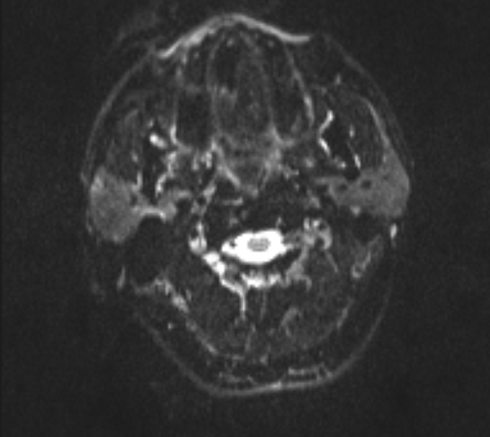 Acute ischemic stroke - posterior circulation territory (Radiopaedia 77670-89880 Axial DWI 1).jpg