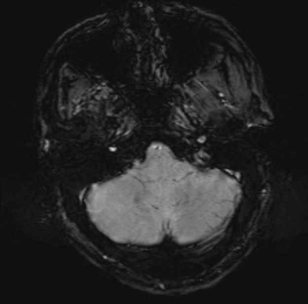Acute ischemic stroke - posterior circulation territory (Radiopaedia 77670-89880 Axial SWI 11).jpg