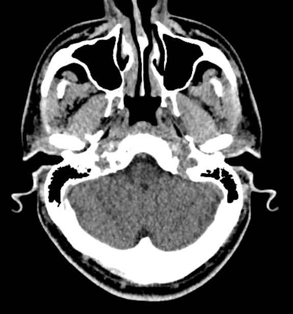Acute ischemic stroke - posterior circulation territory (Radiopaedia 77670-89881 non-contrast 13).jpg