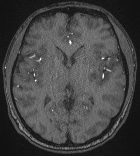 Acute left middle cerebral artery territory infarct with clot retrieval (Radiopaedia 47732-52433 Axial MRA 34).png