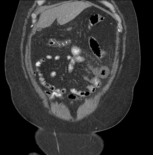Acute mesenteric venous ischemia (Radiopaedia 46041-50383 Coronal C+ portal venous phase 21).jpg