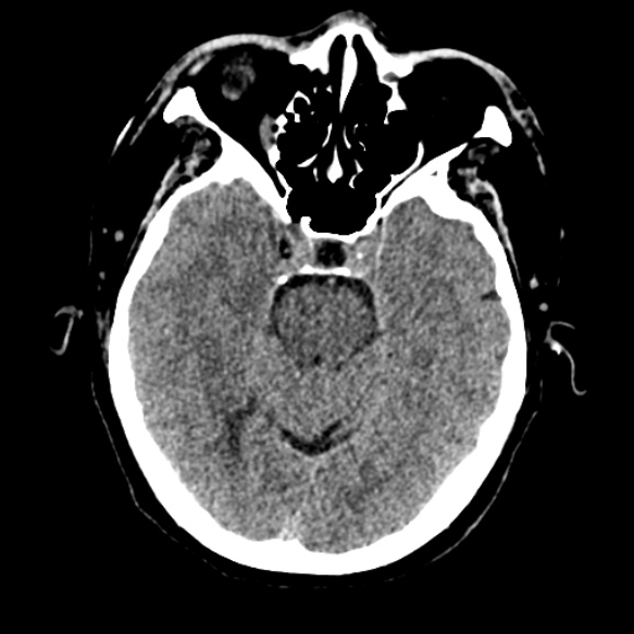 Acute middle cerebral artery territory infarct (Radiopaedia 52380-58283 Axial non-contrast 32).jpg