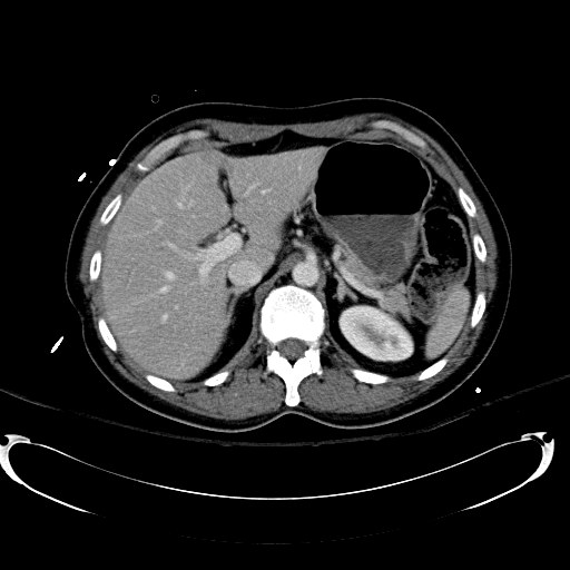 File:Acute myocardial infarction in CT (Radiopaedia 39947-42415 Axial C+ portal venous phase 35).jpg