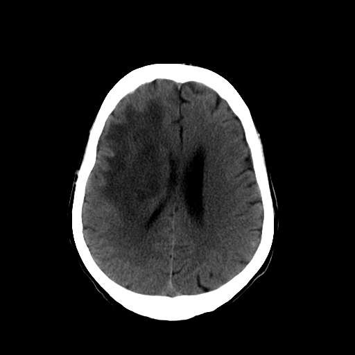 File:Acute necrotizing toxoplasma encephalitis (Radiopaedia 10683-11150 B 12).jpg