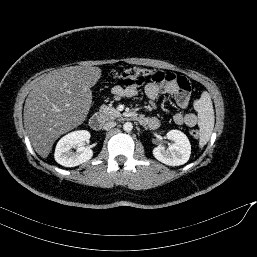Acute on chronic pancreatitis (Radiopaedia 80902-94423 Axial C+ portal venous phase 74).jpg