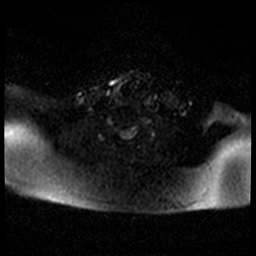 File:Acute otitis externa (Radiopaedia 57296-64236 Axial DWI 57).jpg