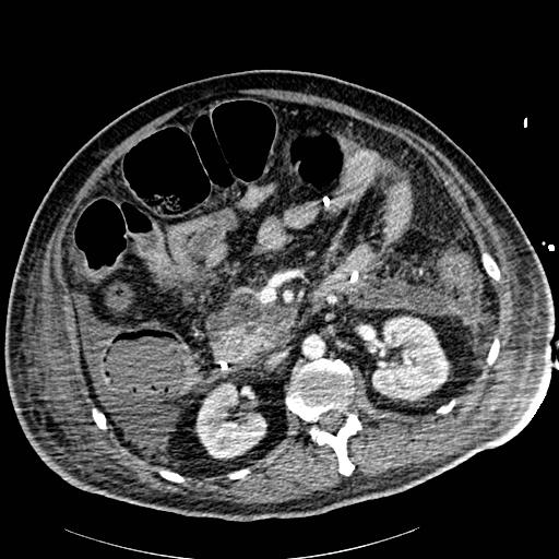 File:Acute pancreatic necrosis (Radiopaedia 13560-18502 Axial C+ portal venous phase 39).jpg