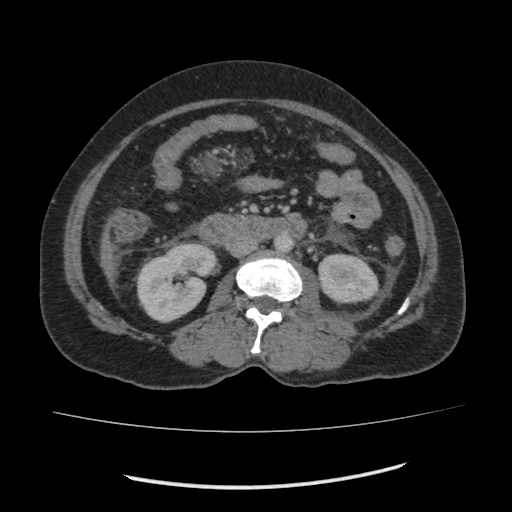 Acute pancreatitis (Radiopaedia 80007-93285 Axial C+ portal venous phase 100).jpg
