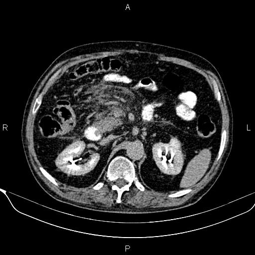 File:Acute pancreatitis (Radiopaedia 85146-100701 Axial C+ delayed 25).jpg