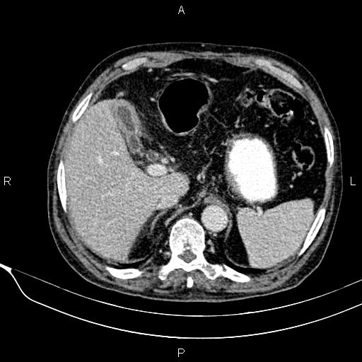 Acute pancreatitis (Radiopaedia 85146-100701 Axial C+ portal venous phase 19).jpg