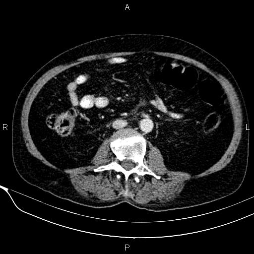 Acute pancreatitis (Radiopaedia 85146-100701 Axial C+ portal venous phase 37).jpg