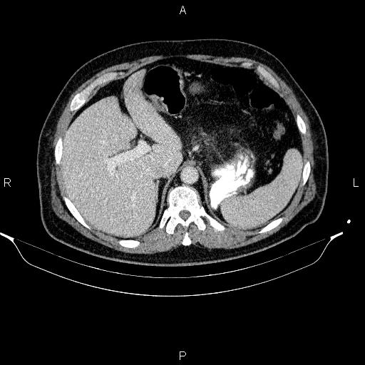 Acute pancreatitis (Radiopaedia 85390-101010 Axial C+ portal venous phase 24).jpg