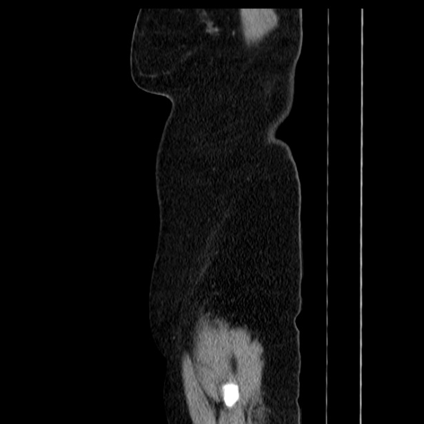 Acute pancreatitis - Balthazar C (Radiopaedia 26569-26714 Sagittal C+ portal venous phase 65).jpg