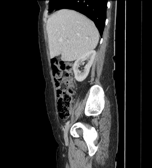Acute pancreatitis - Balthazar E - post ERCP (Radiopaedia 27562-27772 Sagittal C+ portal venous phase 32).png
