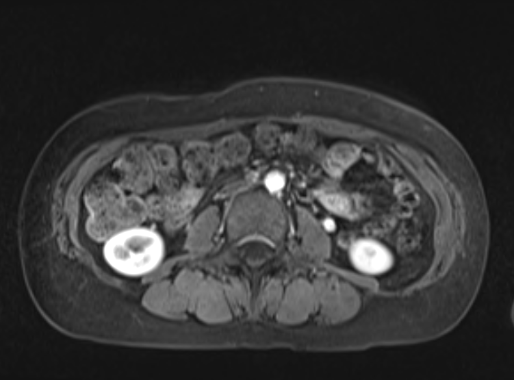 Acute pancreatitis - Balthazar E - post ERCP (Radiopaedia 27562-27778 Axial VIBE C+ 68).png