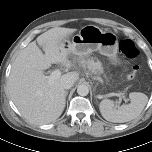 File:Acute pancreatitis and walled-off necrosis (Radiopaedia 29888-30403 Axial C+ delayed 22).jpg