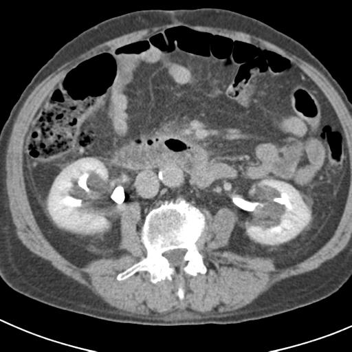 File:Acute pancreatitis and walled-off necrosis (Radiopaedia 29888-30403 Axial C+ delayed 42).jpg