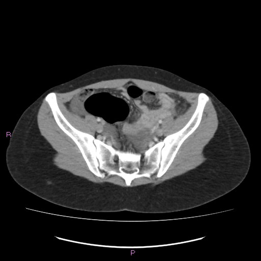 Acute pancreatitis secondary to stone at minor papilla and pancreatic divisum (Radiopaedia 76570-88333 Axial C+ portal venous phase 62).jpg