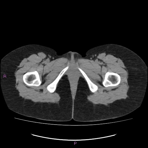 Acute pancreatitis secondary to stone at minor papilla and pancreatic divisum (Radiopaedia 76570-88333 Axial non-contrast 86).jpg