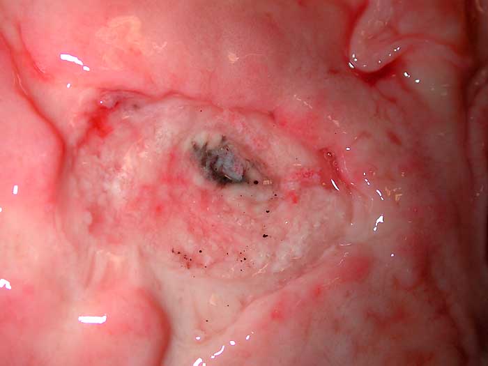File:Acute peptic duodenal ulcer (gross pathology) (Radiopaedia 30074).jpeg