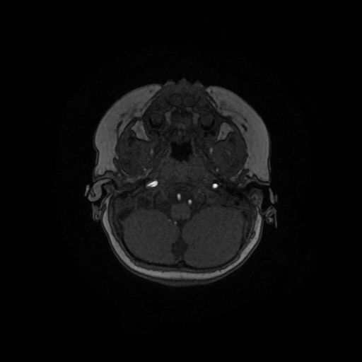 File:Acute phase of hemiconvulsion-hemiplegia epilepsy syndrome (Radiopaedia 29309-29745 Axial TOF angiography 136).jpg