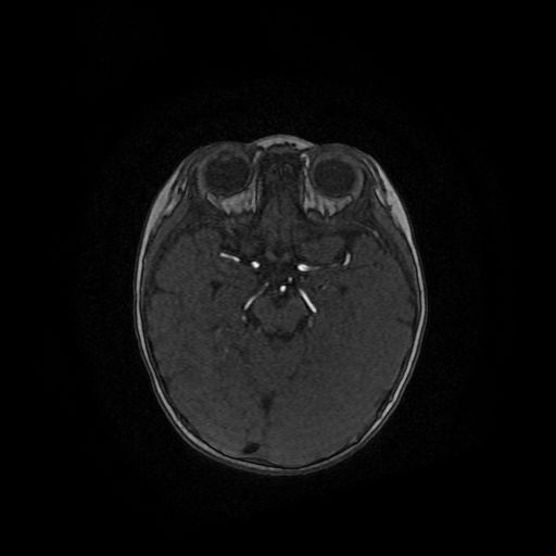 File:Acute phase of hemiconvulsion-hemiplegia epilepsy syndrome (Radiopaedia 29309-29745 Axial TOF angiography 83).jpg